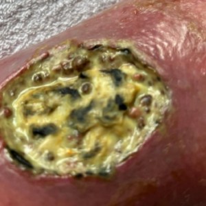 Infected wounds